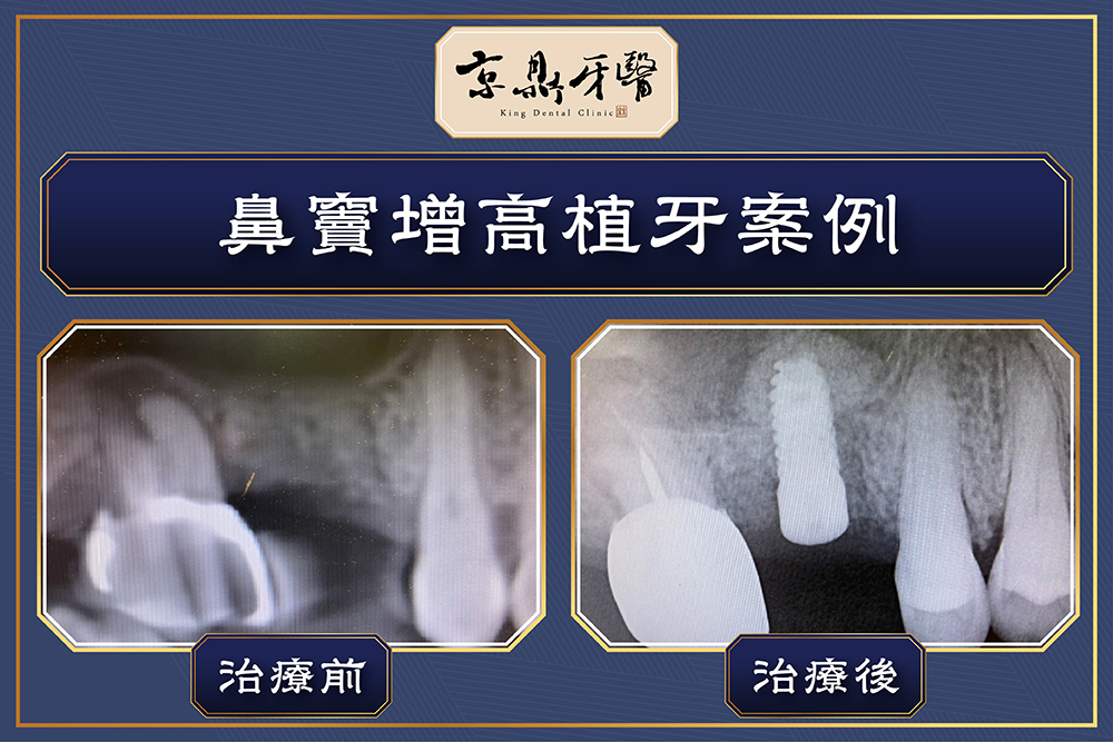 鼻竇增高植牙